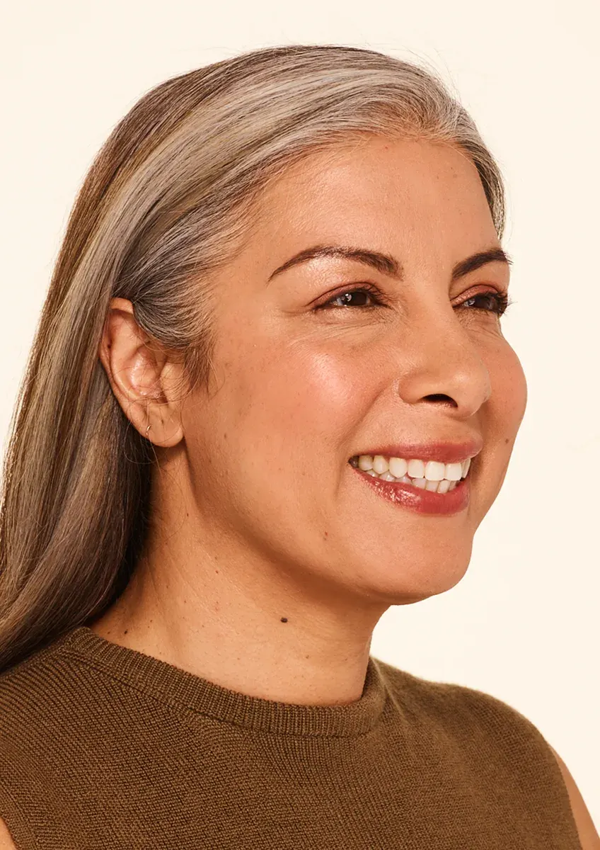 Delfina after BOTOX Cosmetic treatment