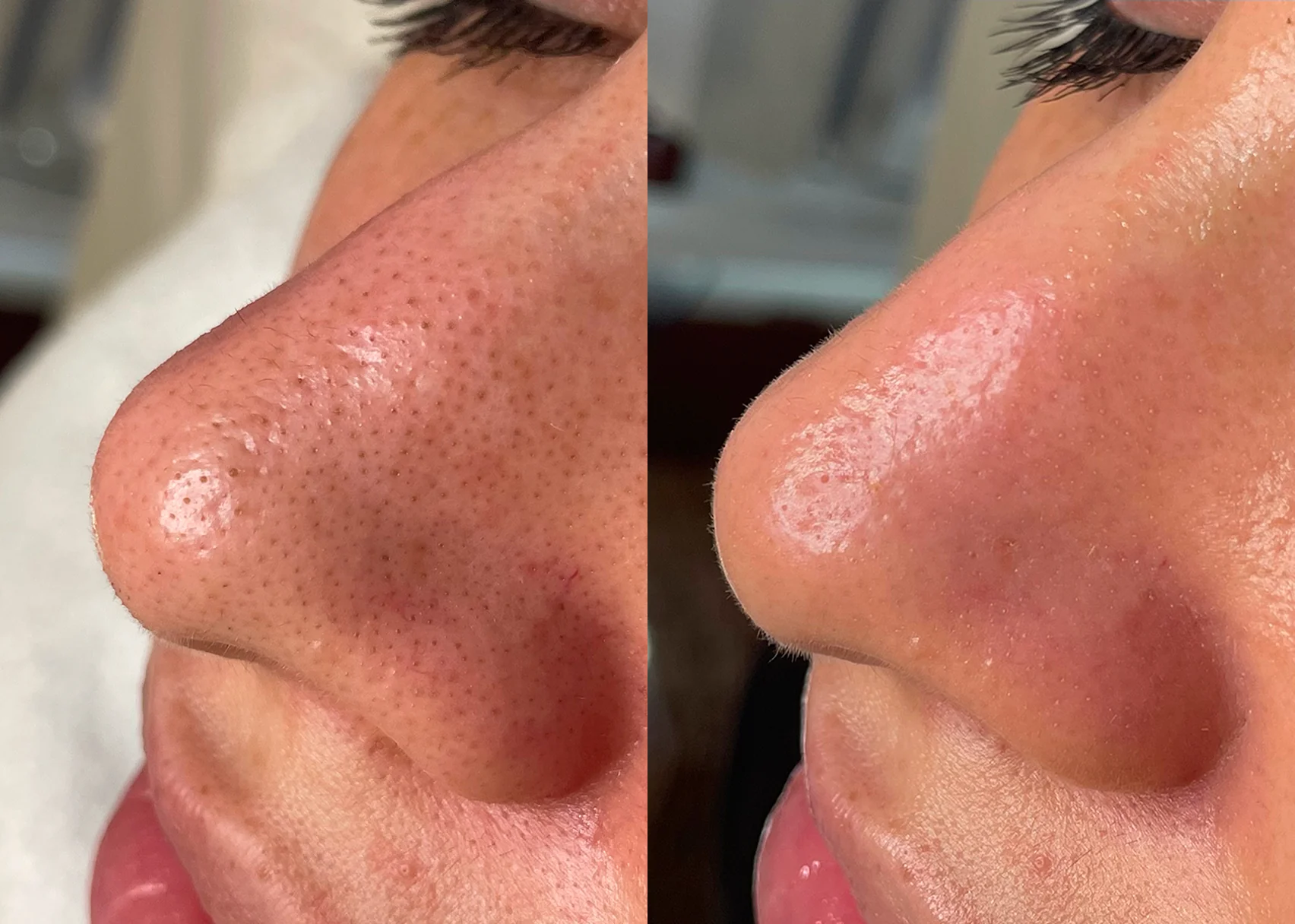 Hydrafacial before and after example for clogged pores
