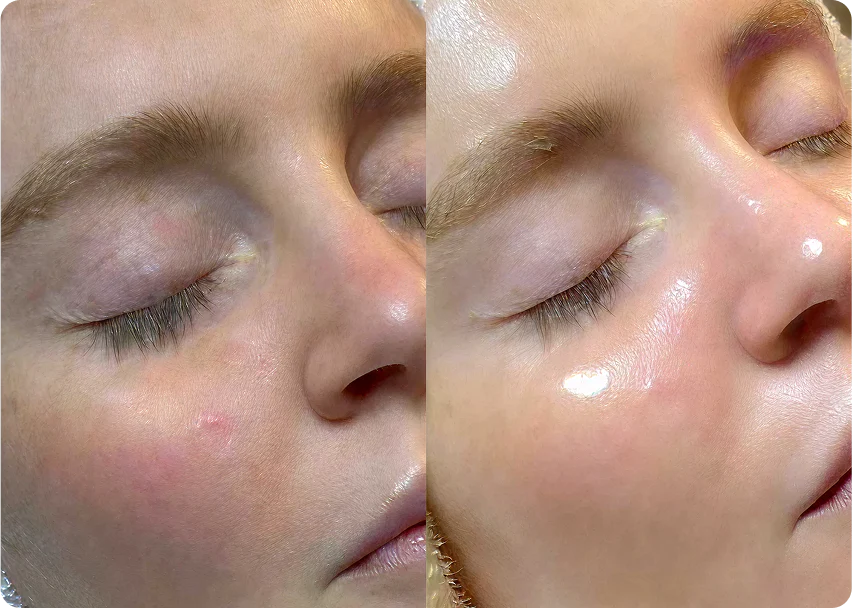 Hydrafacial before and after example for glow and hydration