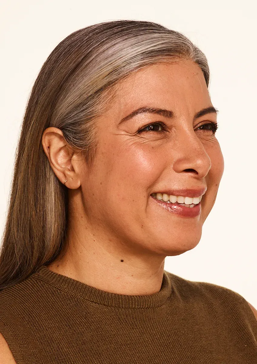 Delfina before BOTOX Cosmetic treatment