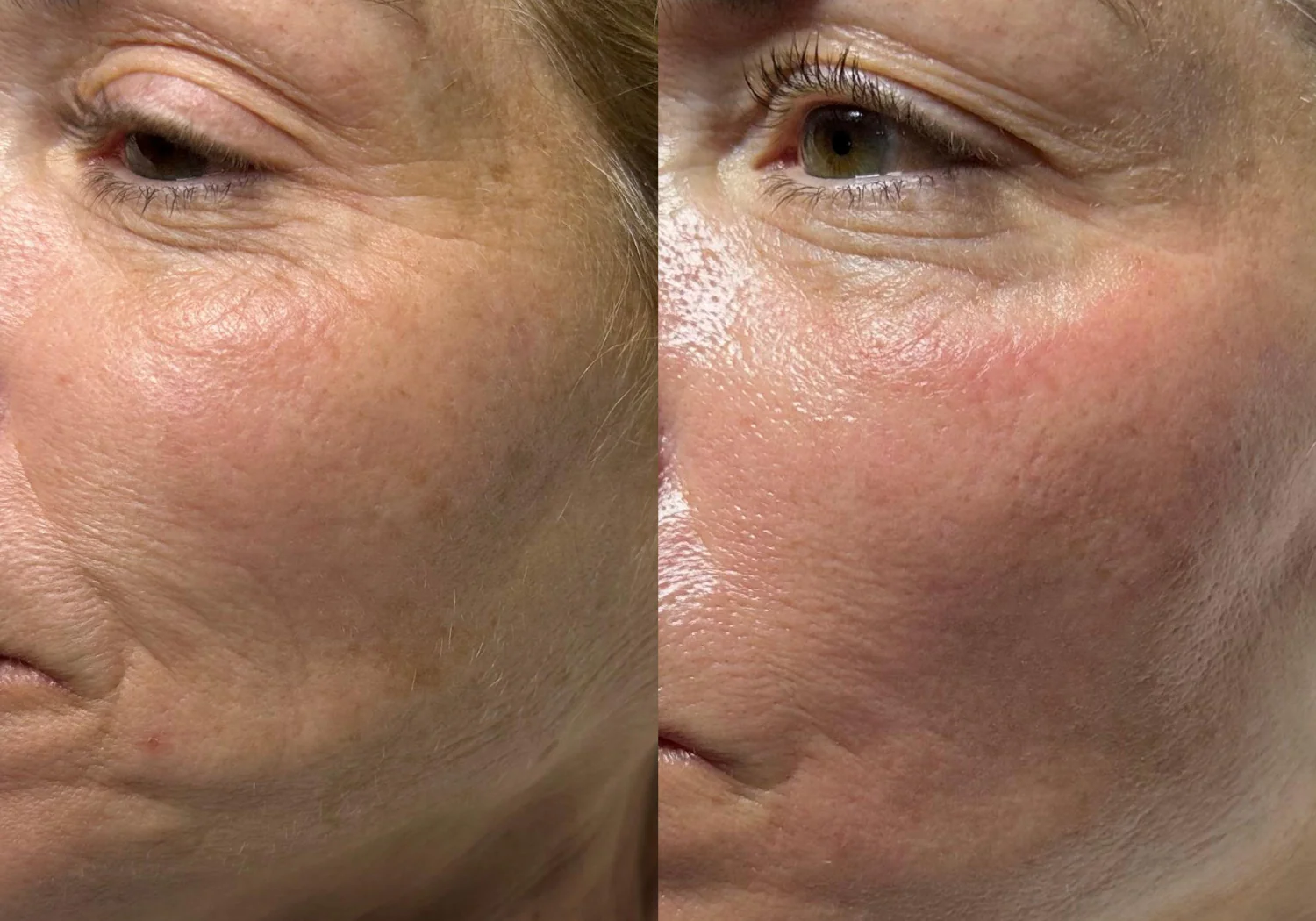 Hydrafacial before and after example for fine lines and wrinkles
